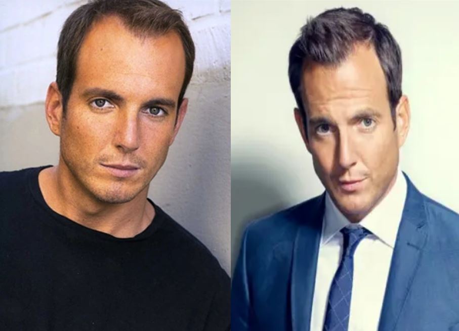Is Will Arnett's Lush Hair a Testament to Hair Transplant revealed in detail.