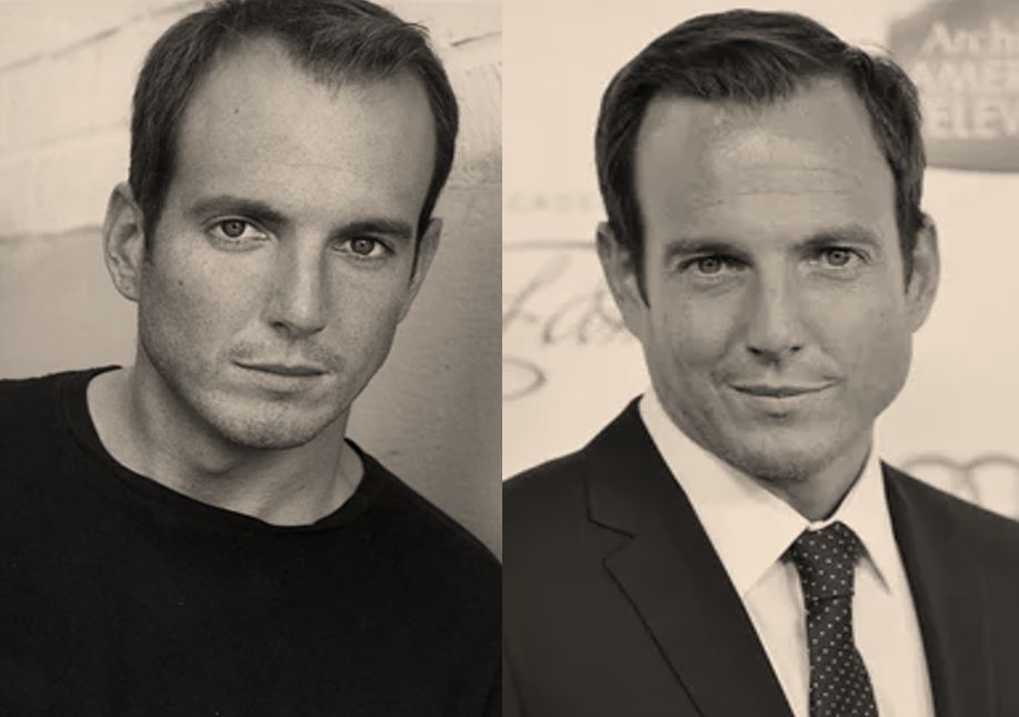 Will Arnett Hair Transplant Before After